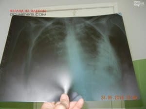 В Одессе пациента с туберкулезом поместили в общую палату